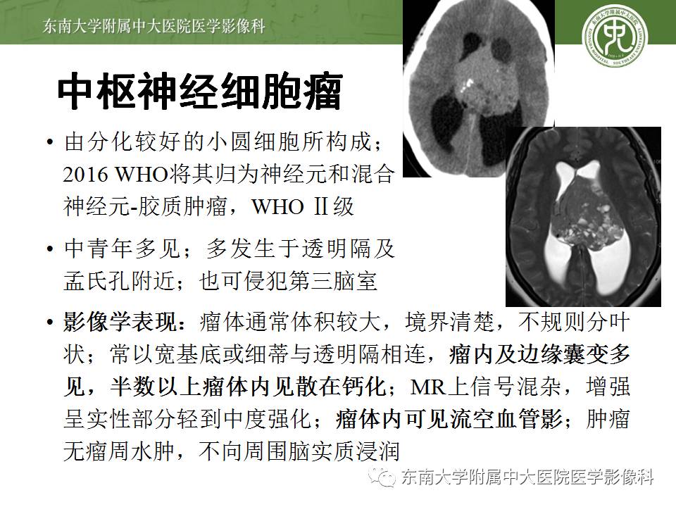 【病例】侧脑室脉络丛乳头状瘤1例MR影像特点