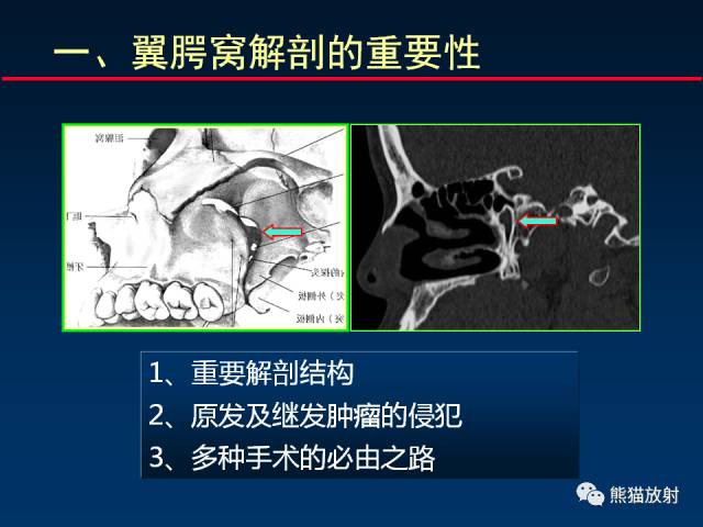 【PPT】MSCT后处理技术在显示翼腭窝解剖中的作用