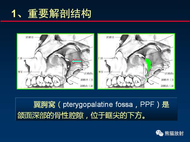 【PPT】MSCT后处理技术在显示翼腭窝解剖中的作用