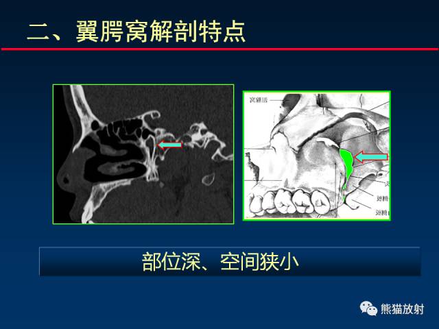 【PPT】MSCT后处理技术在显示翼腭窝解剖中的作用