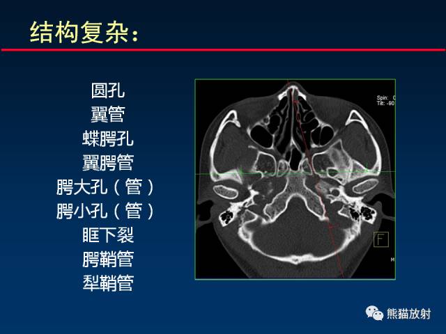 【PPT】MSCT后处理技术在显示翼腭窝解剖中的作用