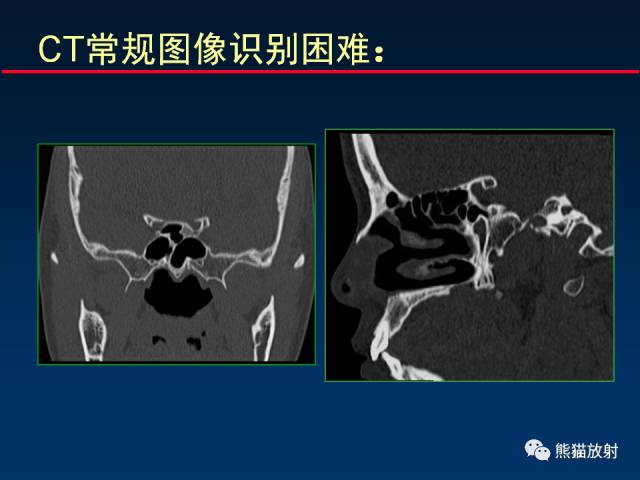 【PPT】MSCT后处理技术在显示翼腭窝解剖中的作用