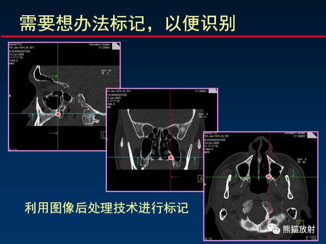 【PPT】MSCT后处理技术在显示翼腭窝解剖中的作用
