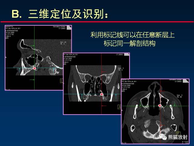 【PPT】MSCT后处理技术在显示翼腭窝解剖中的作用