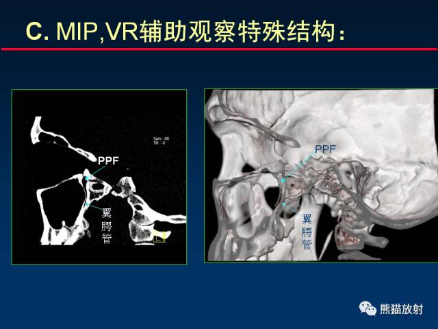 【PPT】MSCT后处理技术在显示翼腭窝解剖中的作用