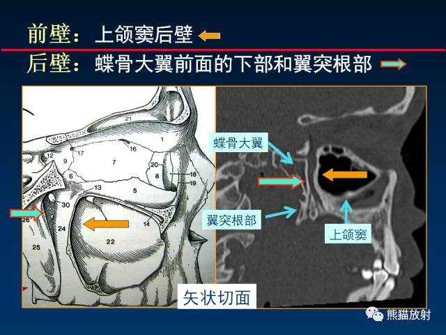 【PPT】MSCT后处理技术在显示翼腭窝解剖中的作用
