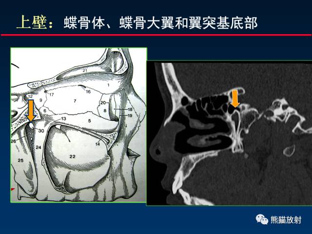 【PPT】MSCT后处理技术在显示翼腭窝解剖中的作用