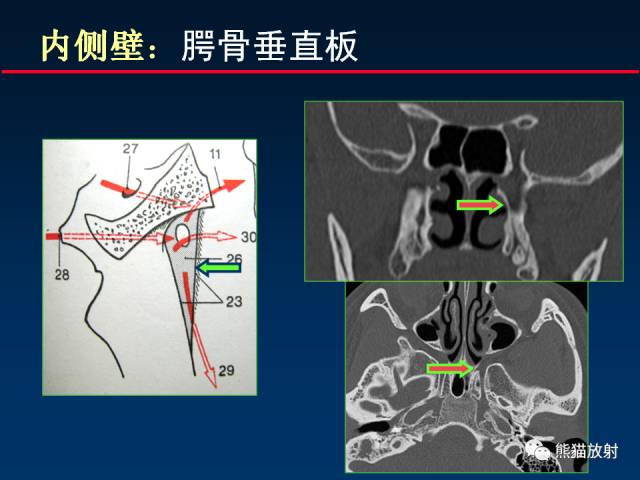 【PPT】MSCT后处理技术在显示翼腭窝解剖中的作用