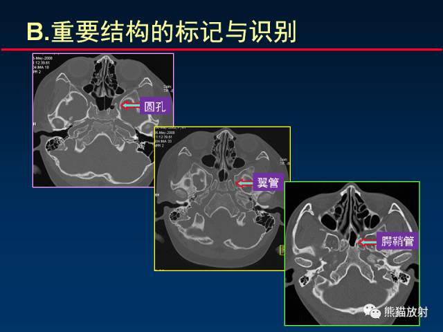 【PPT】MSCT后处理技术在显示翼腭窝解剖中的作用