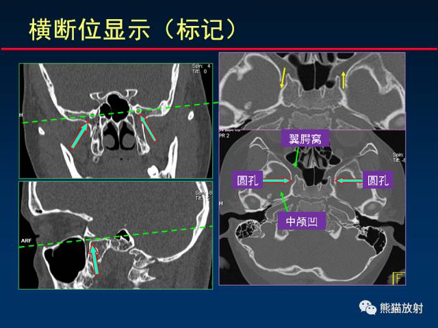 【PPT】MSCT后处理技术在显示翼腭窝解剖中的作用