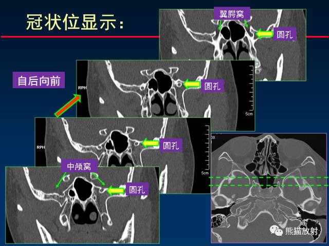 【PPT】MSCT后处理技术在显示翼腭窝解剖中的作用