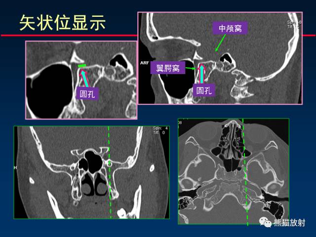 【PPT】MSCT后处理技术在显示翼腭窝解剖中的作用