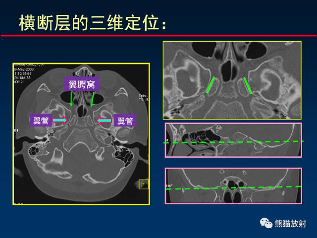 【PPT】MSCT后处理技术在显示翼腭窝解剖中的作用