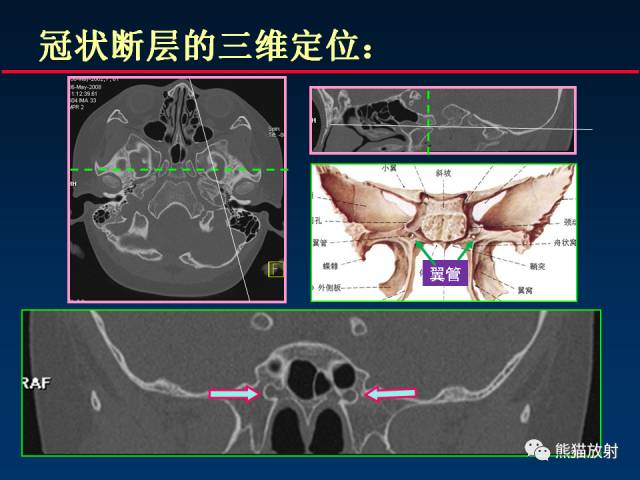 【PPT】MSCT后处理技术在显示翼腭窝解剖中的作用