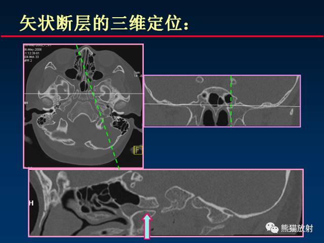 【PPT】MSCT后处理技术在显示翼腭窝解剖中的作用