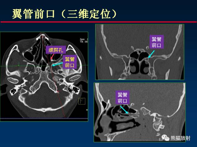 【PPT】MSCT后处理技术在显示翼腭窝解剖中的作用