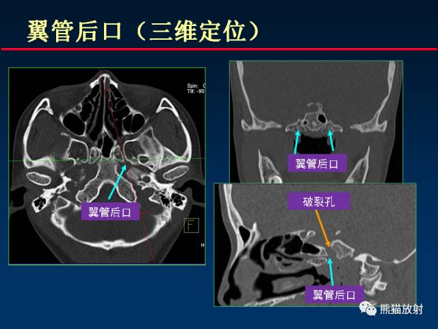 【PPT】MSCT后处理技术在显示翼腭窝解剖中的作用
