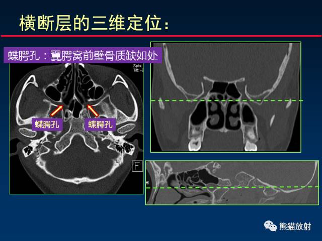 【PPT】MSCT后处理技术在显示翼腭窝解剖中的作用