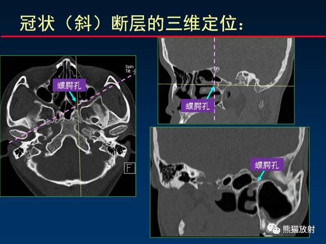 【PPT】MSCT后处理技术在显示翼腭窝解剖中的作用
