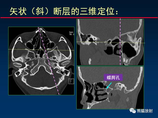 【PPT】MSCT后处理技术在显示翼腭窝解剖中的作用