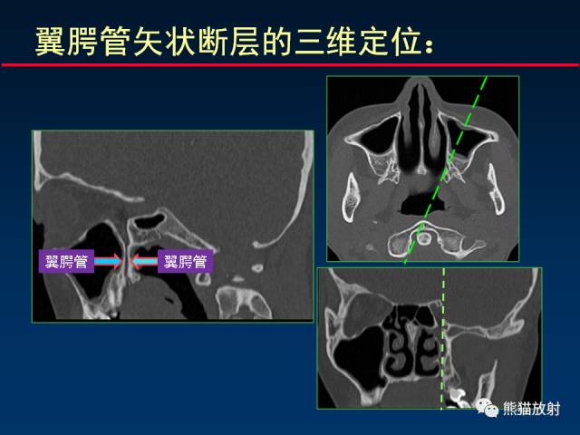 【PPT】MSCT后处理技术在显示翼腭窝解剖中的作用