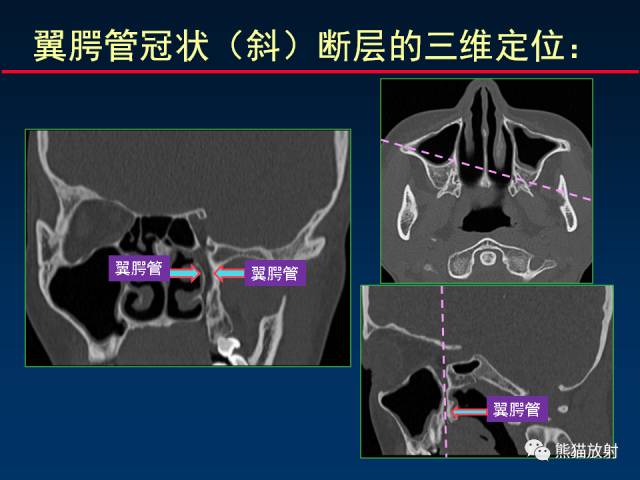 【PPT】MSCT后处理技术在显示翼腭窝解剖中的作用