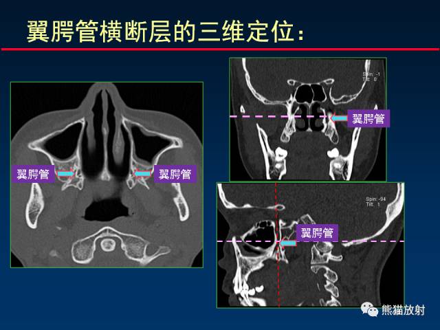 【PPT】MSCT后处理技术在显示翼腭窝解剖中的作用