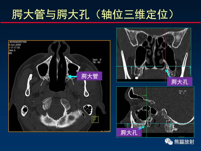 【PPT】MSCT后处理技术在显示翼腭窝解剖中的作用