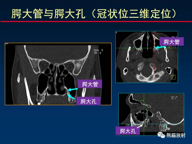 【PPT】MSCT后处理技术在显示翼腭窝解剖中的作用