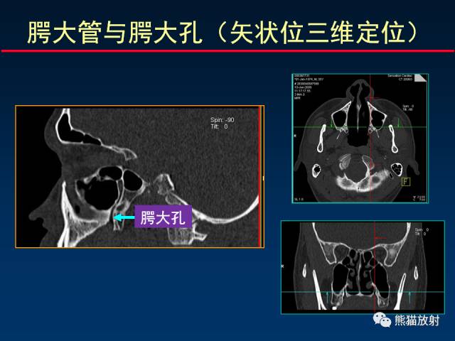 【PPT】MSCT后处理技术在显示翼腭窝解剖中的作用