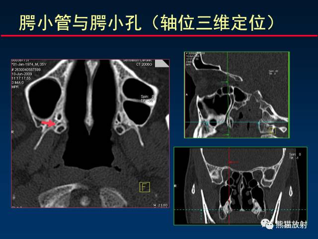 【PPT】MSCT后处理技术在显示翼腭窝解剖中的作用