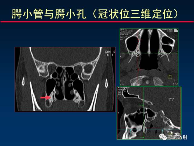 【PPT】MSCT后处理技术在显示翼腭窝解剖中的作用