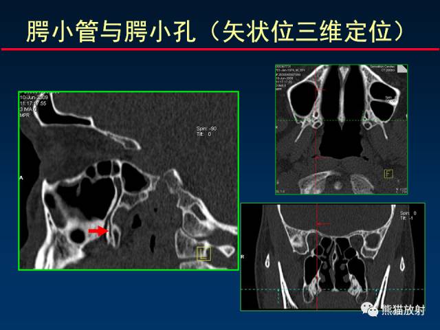【PPT】MSCT后处理技术在显示翼腭窝解剖中的作用