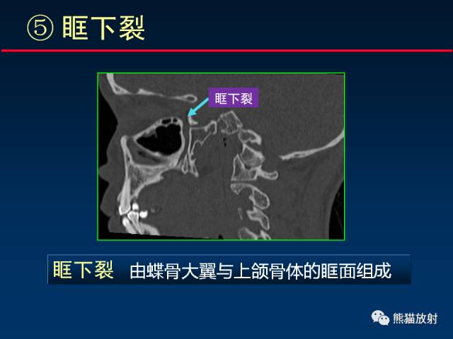 【PPT】MSCT后处理技术在显示翼腭窝解剖中的作用