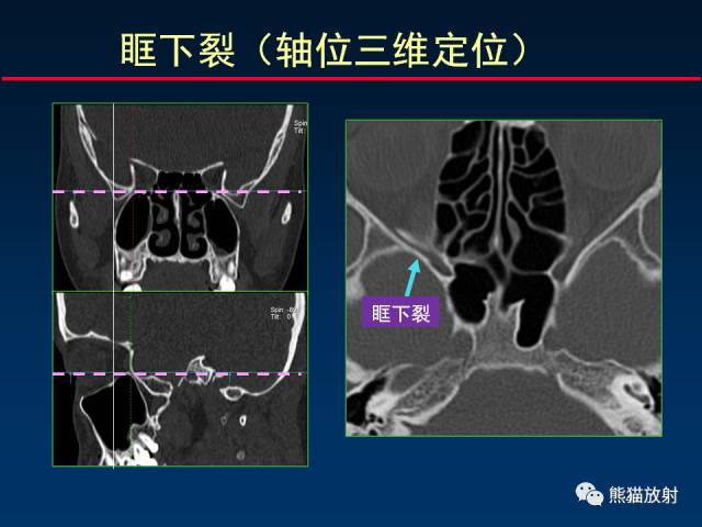 【PPT】MSCT后处理技术在显示翼腭窝解剖中的作用