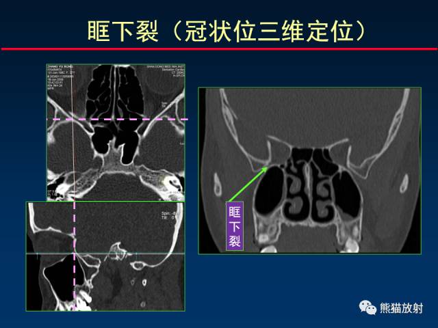 【PPT】MSCT后处理技术在显示翼腭窝解剖中的作用