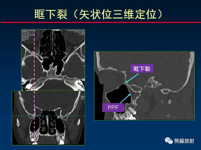 【PPT】MSCT后处理技术在显示翼腭窝解剖中的作用