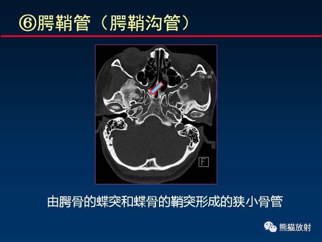 【PPT】MSCT后处理技术在显示翼腭窝解剖中的作用