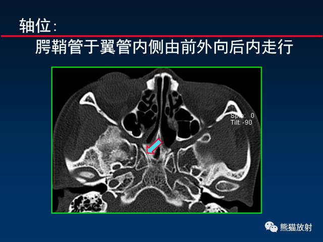 【PPT】MSCT后处理技术在显示翼腭窝解剖中的作用