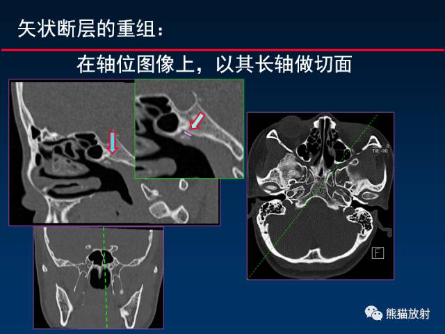 【PPT】MSCT后处理技术在显示翼腭窝解剖中的作用