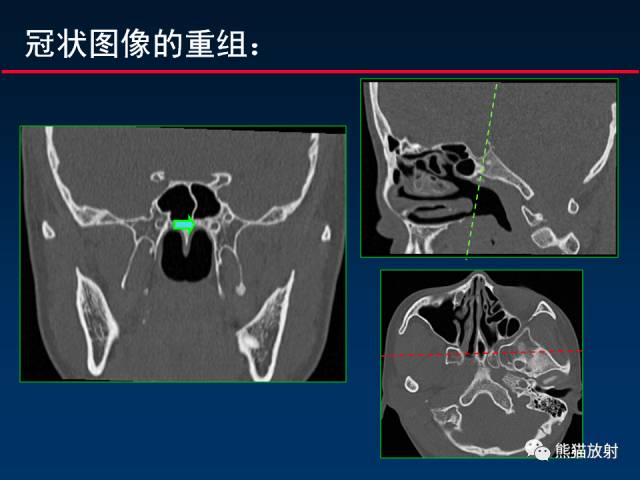 【PPT】MSCT后处理技术在显示翼腭窝解剖中的作用