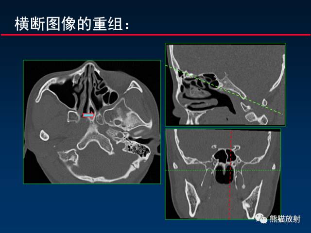 【PPT】MSCT后处理技术在显示翼腭窝解剖中的作用