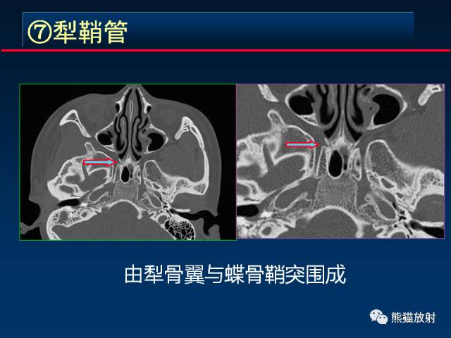 【PPT】MSCT后处理技术在显示翼腭窝解剖中的作用