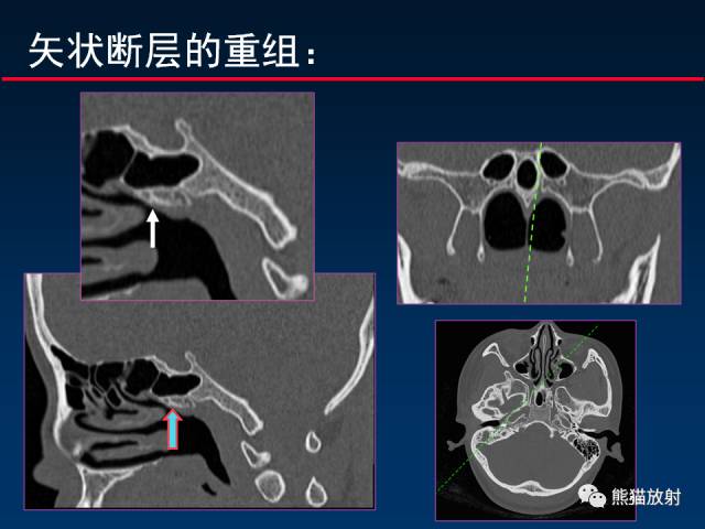 【PPT】MSCT后处理技术在显示翼腭窝解剖中的作用