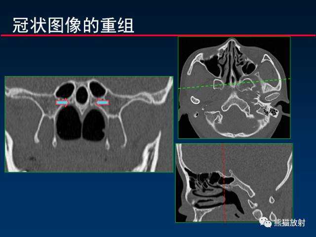【PPT】MSCT后处理技术在显示翼腭窝解剖中的作用