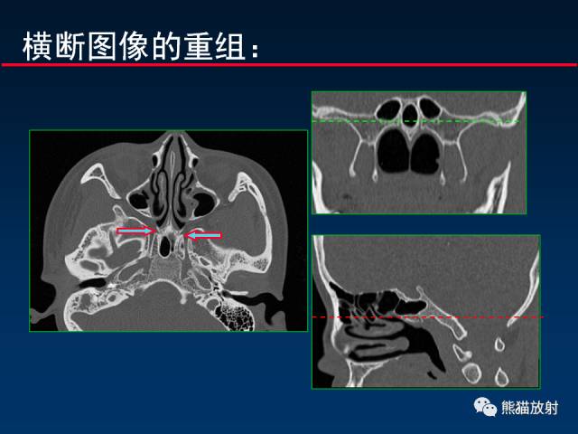 【PPT】MSCT后处理技术在显示翼腭窝解剖中的作用