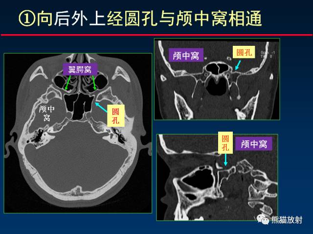 【PPT】MSCT后处理技术在显示翼腭窝解剖中的作用