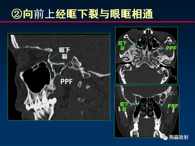 【PPT】MSCT后处理技术在显示翼腭窝解剖中的作用