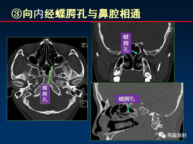 【PPT】MSCT后处理技术在显示翼腭窝解剖中的作用