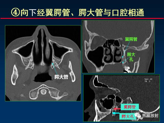 【PPT】MSCT后处理技术在显示翼腭窝解剖中的作用